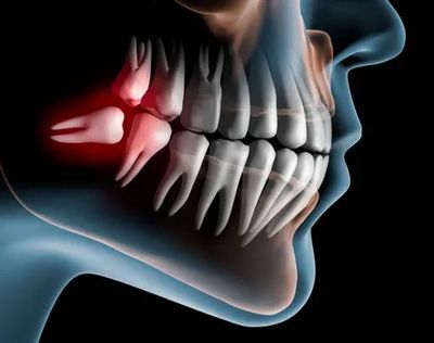 X-ray of horizontally impacted tooth.