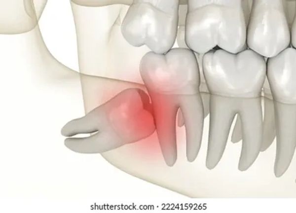 Diagram of impacted wisdom tooth. infected wisdom tooth