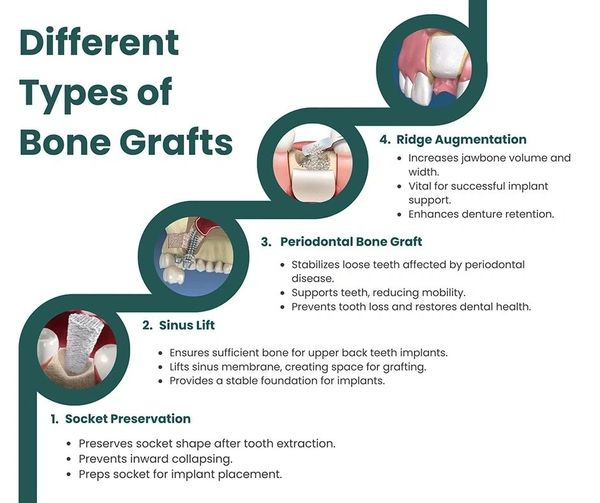 Types of dental bone grafts.