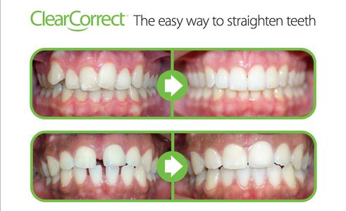 ClearCorrect Aligners Braces
Invisible braces
Retainers
Tooth Whitening
Straight Teeth