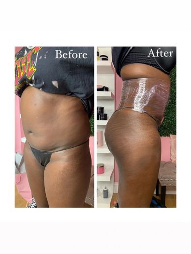 Non Surgical Fat Reduction & Buttocks Enhancement with Stomach Wrap
