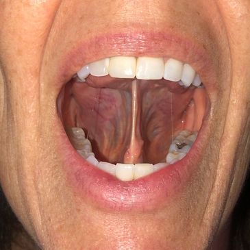 tongue tie, ankyloglossia, tongue space, narrow palate, orthodontic relapse, lingual palatal seal