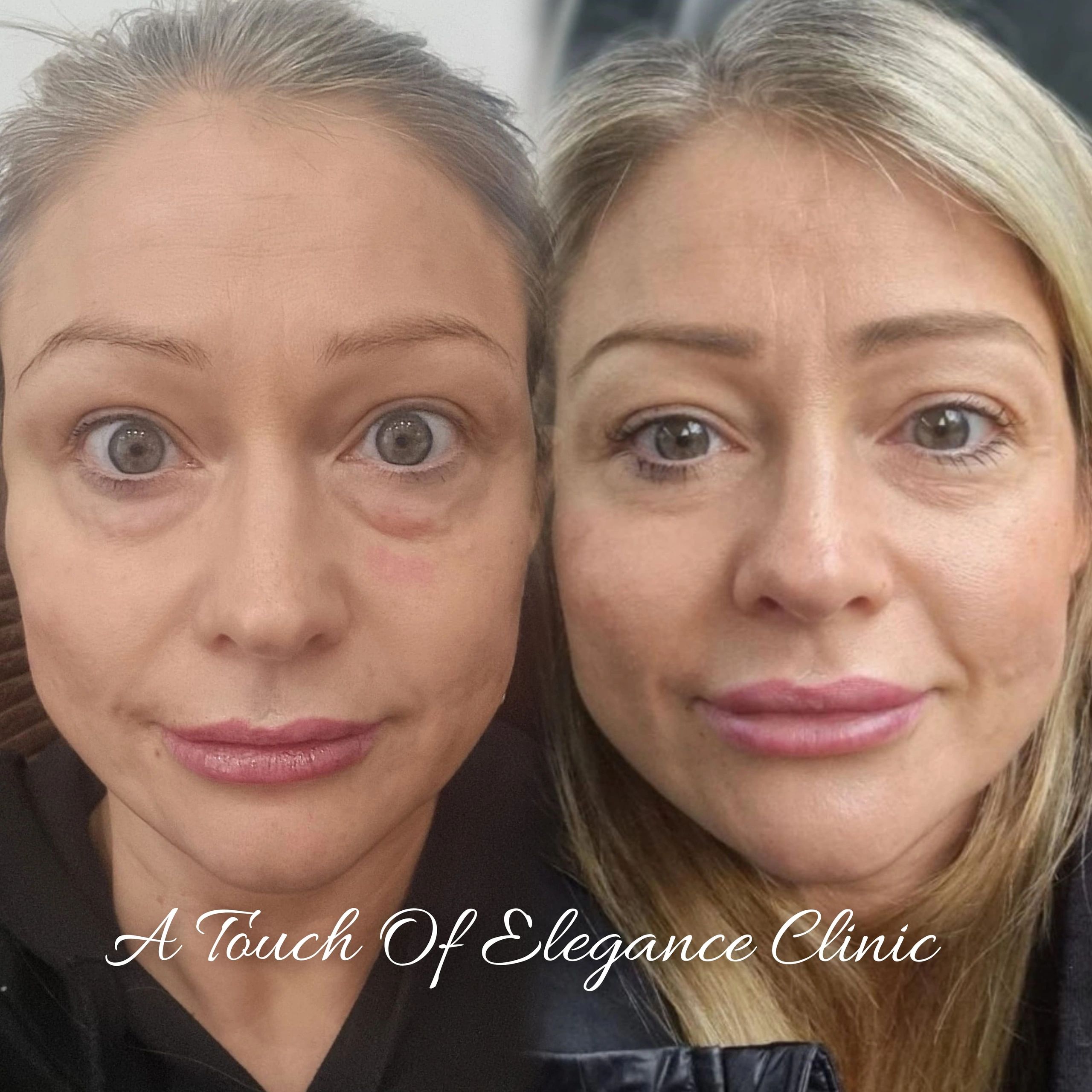 Cheek fillers London