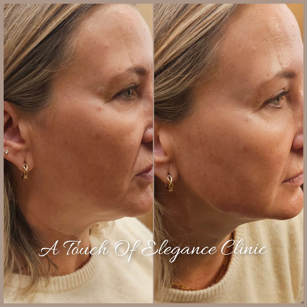 Jawline slimming Croydon