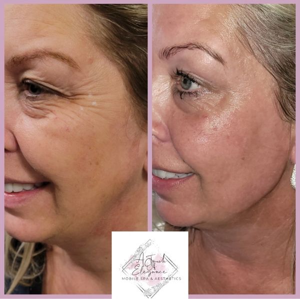 Jawline filler Croydon