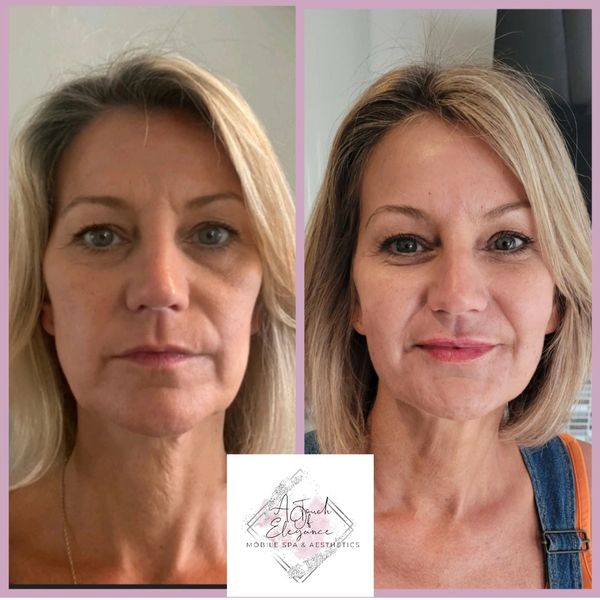 Cheek Fillers Croydon