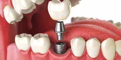 Protesi dentale fissa, corone in zirconio.  Centro Sanident Salerno.