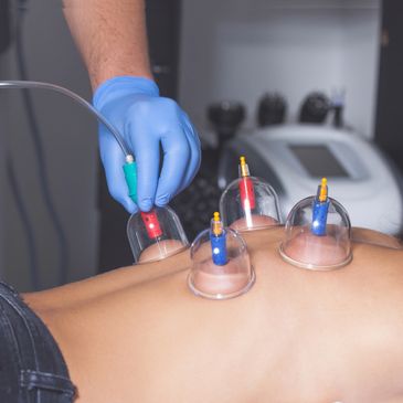 Cupping Massage Reno Nevada
