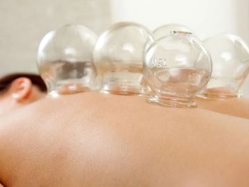 Cupping therapy using glass cups on a client's back.