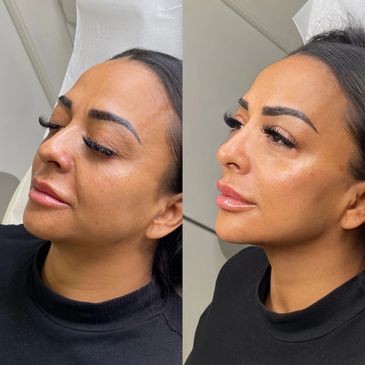 Face Sculpting Package