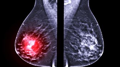 Image of mammogram with cancer.