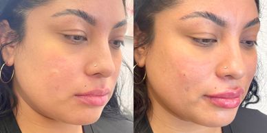 cheek filler in st george utah for higher cheekbones and midface support