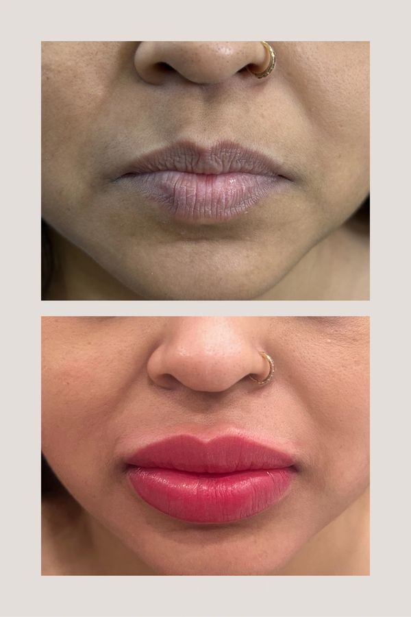 before and after effect of lip neutralization and lip blush