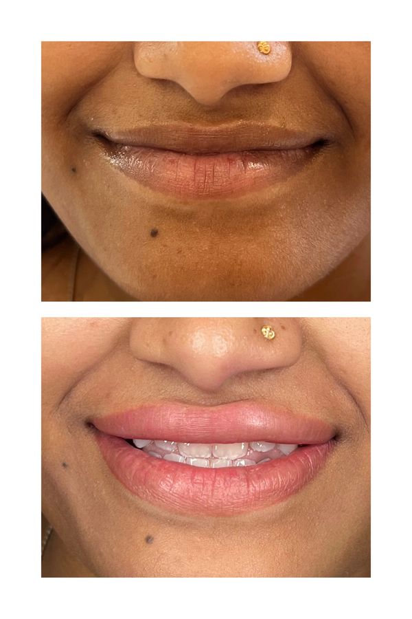 before and after effect of lip neutralization and lip blush