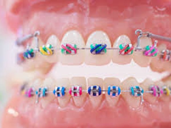 Close-up of teeth with colorful braces.