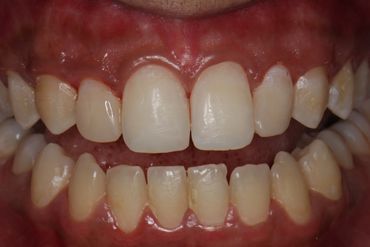 smile tooth coloured fillings