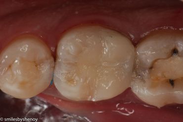 tooth coloured fillings