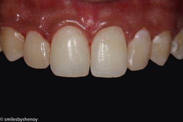 smile tooth coloured fillings