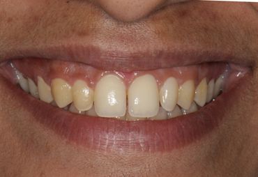 tooth coloured fillings