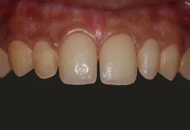 smile tooth coloured fillings