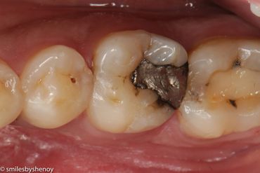 tooth coloured fillings