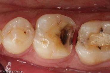 tooth coloured fillings