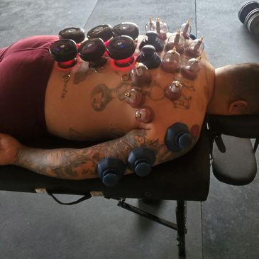 cupping therapy in Manteca, ca