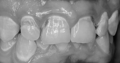 Severe enamel damage commonly found following orthodontic treatment