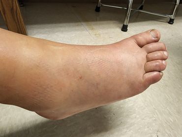 Swollen foot with visible skin texture, resting on a tiled floor.