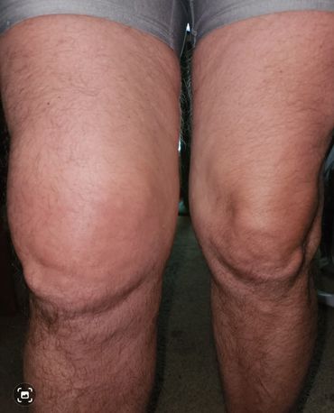 One knee appears swollen compared to the other.