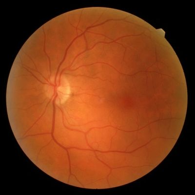 A high resolution image of the back of the eye