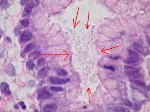 
Helicobacter Pylori in the Gastric Mucosa (red arrow) jeffrey dach md 