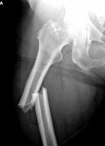 Fosamax Induced Femur Fracture