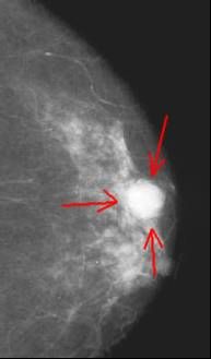 Breast Cancer on Mammogram Jeffrey Dach MD