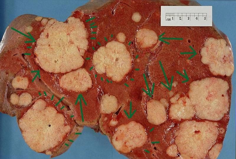 Pancreatic Cancer Metstatic Deposits in the Liver