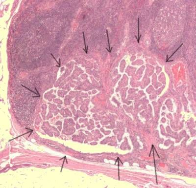 Papillary thyroid cancer in lymph node