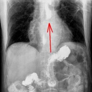 GE reflux on barium X Ray
