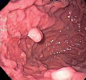Gastric Polyps from PPIs