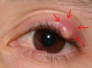 Chalazion of the Meibomian Gland, Testosterone for Dry Eyes