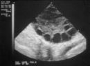 PCOS Ultrasound showing ovarian cysts