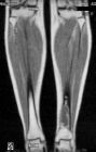MRI scan of Leg muscles for leg pain lipitor statin drug