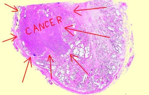 Prostate Cancer Biopsy Sample Histology Slide