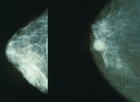 Mammogram showing breast cancer mass (white lump)