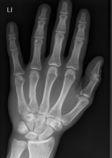 menopausal arthritis hand xray with fracture finger and negative for arthritis