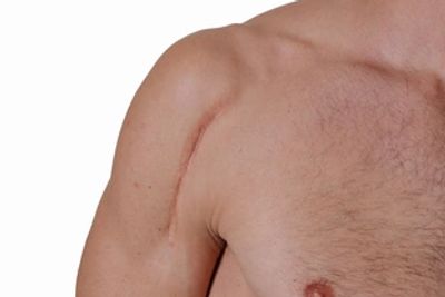 Scar Therapy, Scar Reduction, sports injury treatment. Men's health doctor Chandler Arizona