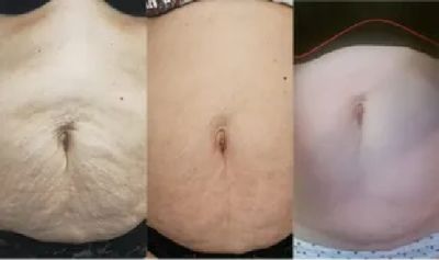 Images of cellulite