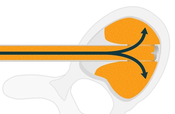 KG1 bifurcated graft delivery