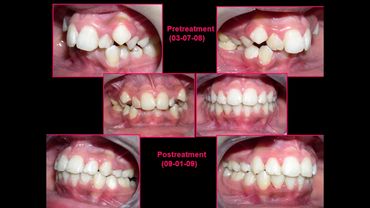 Orthodontic Treatment for crowded teeth at Align Orthodontics