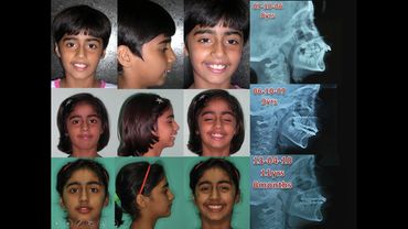 Dr. Anil Sharma Orthodontic cases, Best Orthodontist Jalandhar, Best Orthodontist Gurgaon, Braces