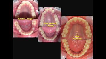 Class II malocclusion treated by braces at Align Orthodontics
